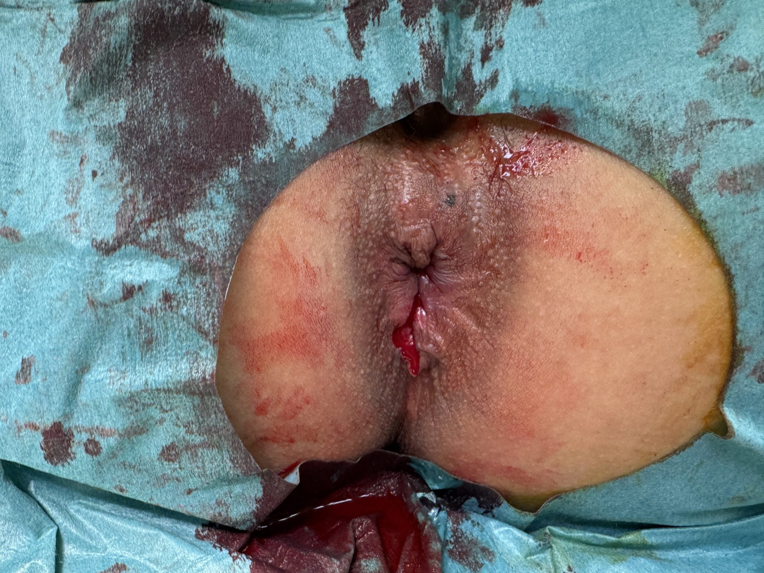 After hemorrhoid laser surgery (blurred by default). Click to reveal.
